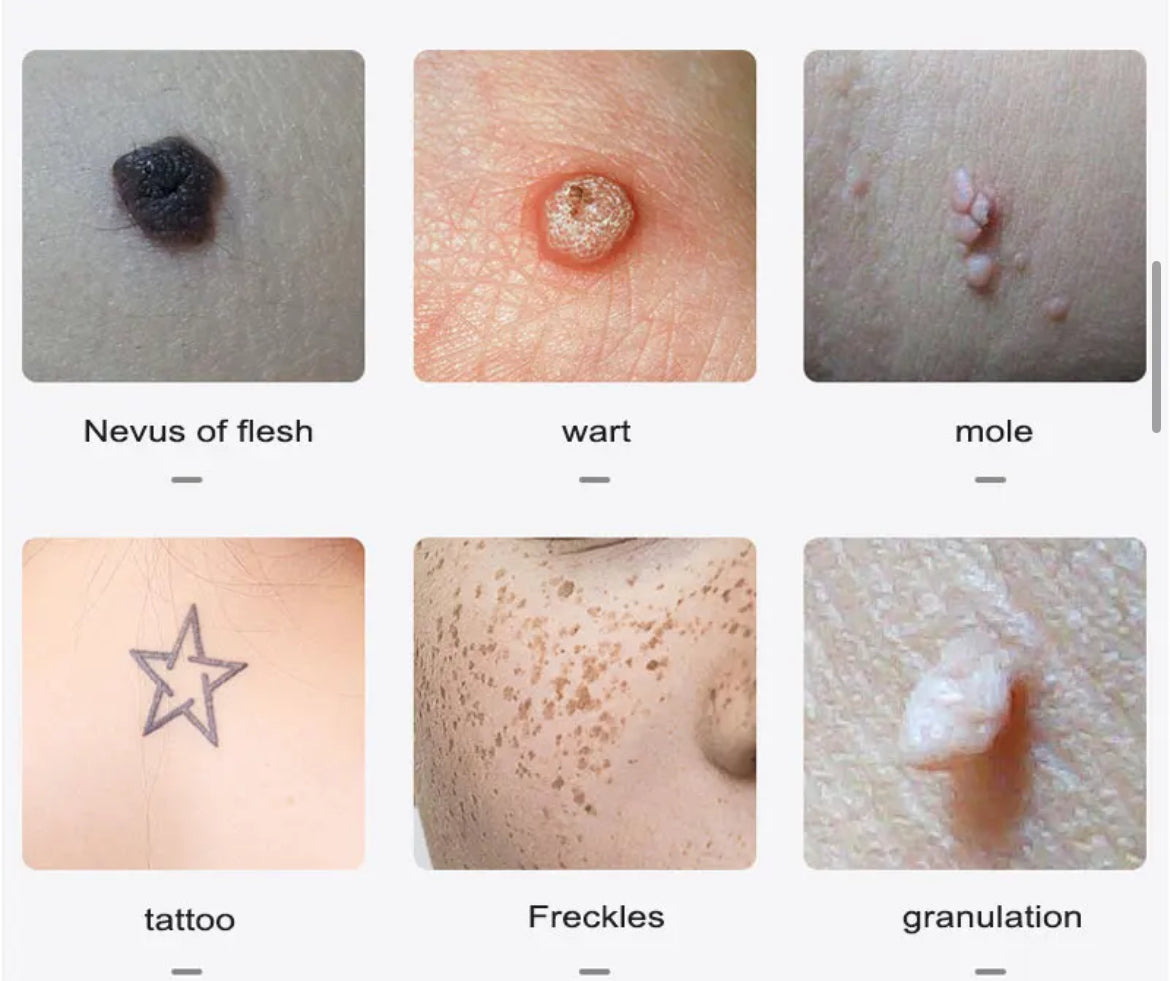 Plasma Pen Plasmage