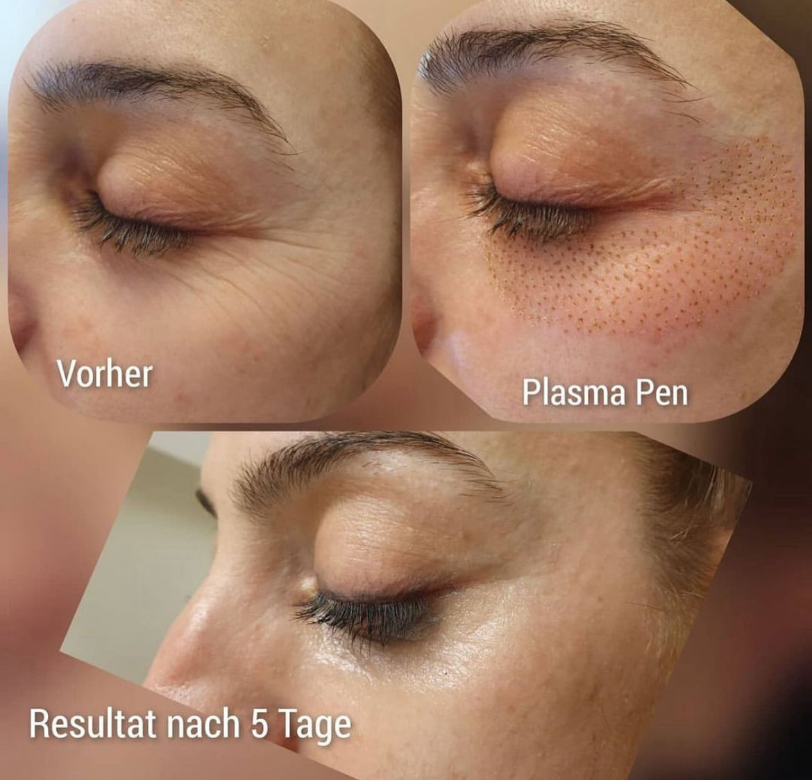 Plasmage