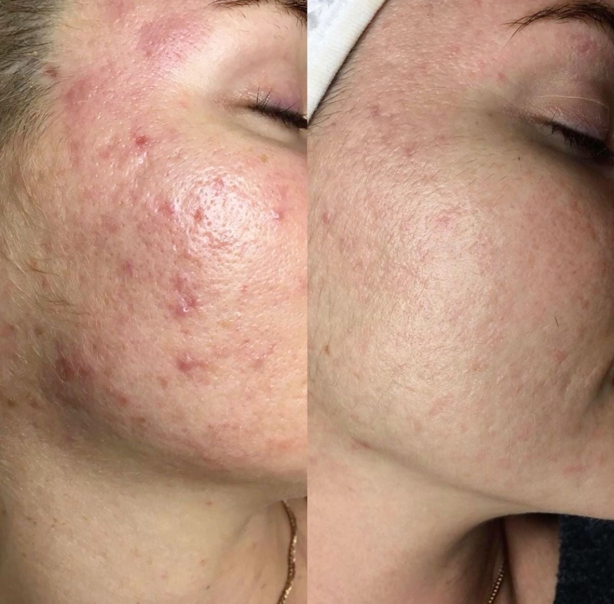 Kosmetische Fruchtsäure Peeling Behandlung mit PRX-T33