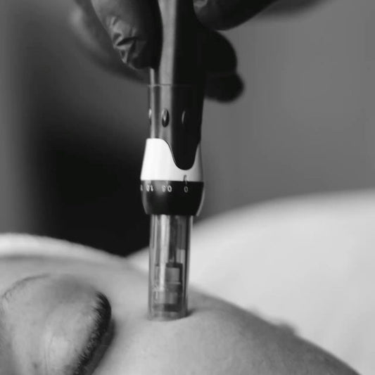 MICRONEEDLING